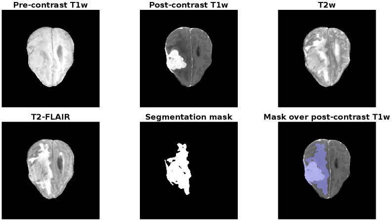 A Unified Benchmark of Deep Learning Models for Multi-task 3D Brain Tumor Segmentation from Magnetic Resonance Imaging Figure 1