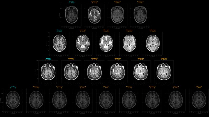 Beyond Random Partitioning: Unsupervised Spatio-Temporal Stratification for Cohort Balancing in Longitudinal Medical Imaging Figure 1