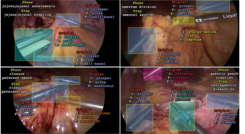 SPIRIT: Spatio-temporal Pairwise Relational Modeling of Instrument-Tissue Interactions for Surgical Action Triplet Recognition Figure 1