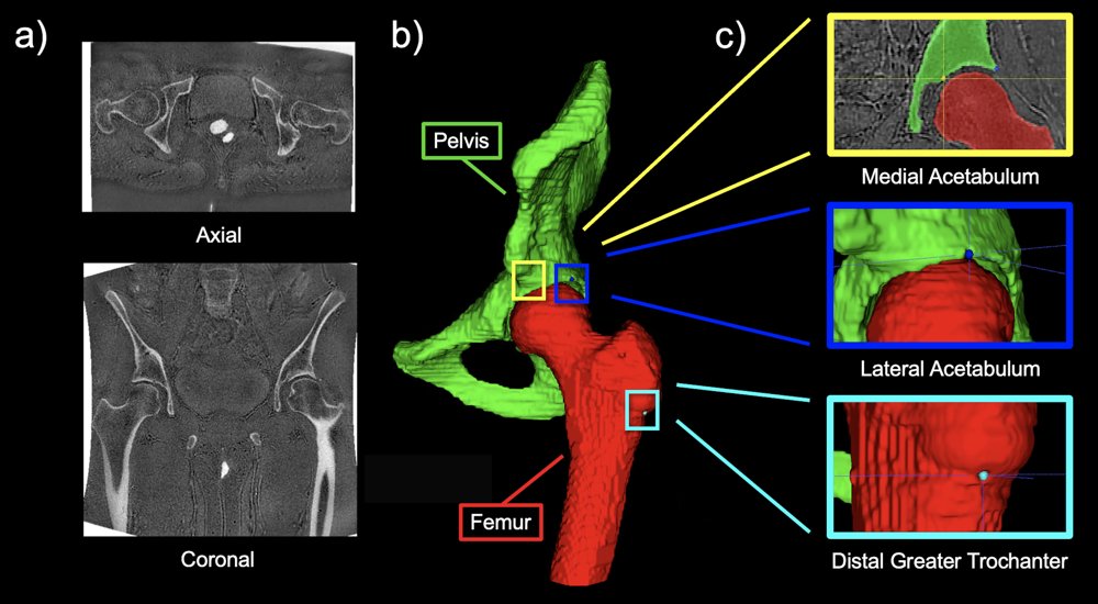 Measurements Automatically Extracted from Zero Echo Time MRI Using Deep Learning Image Segmentation and Geometric Modeling Agree with Expert Manual Readings Figure 1