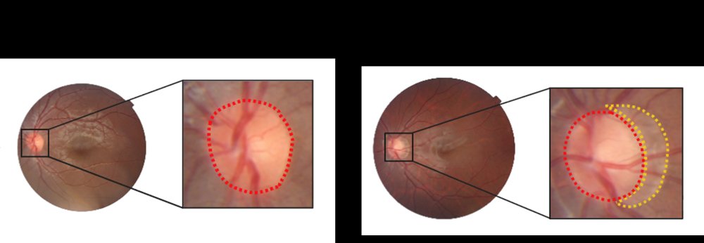 UPolarSQ: Polar Representation Learning for Optic Disc and Peripapillary Atrophy Segmentation and Quantification in Fundus Photographs Figure 1