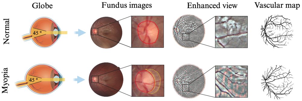 SpecF2M: A Spectral-Aware Multi-task Network Estimating Axial Length and Refractive Error from Pediatric Fundus Photographs Figure 1