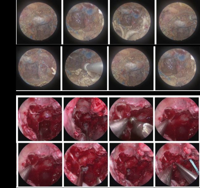 EndoLive: Real-Time Style Transfer for Endoscopic Endonasal Skull Base Surgical Video Figure 1