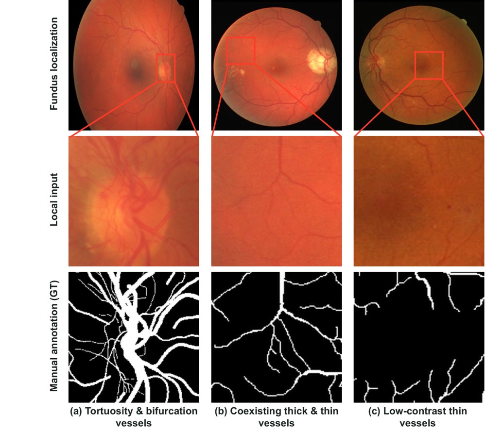CGDD-Net: Context-Guided Dynamic Detail Modeling for Retinal Vessel Segmentation Figure 1