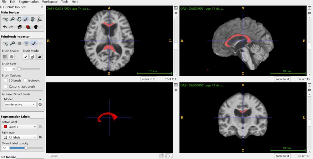 Riemannian Shape Analysis of the Corpus Callosum in Kendall Space: Aging and Alzheimer's Disease Figure 1