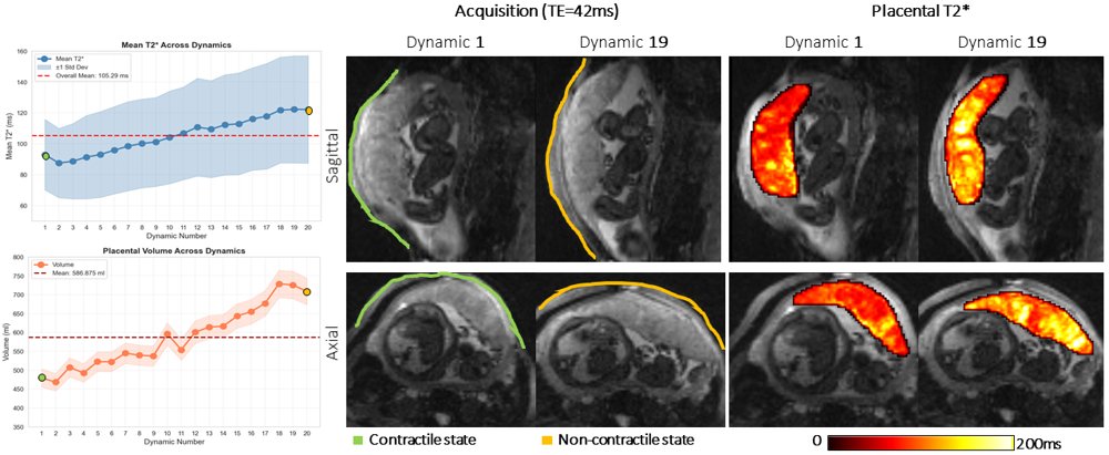 STORK: Spatio-Temporal Observation of uterine contRactions via neural networKs Figure 1