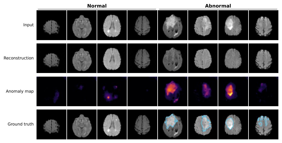 Quasi-Binarized Autoencoders: An Architecture-Independent Information Bottleneck for Medical Image Anomaly Detection Figure 1
