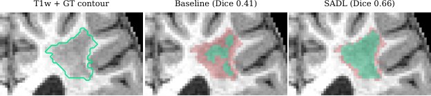 SADL: A Size-Adaptive Decision Layer for Chronic Stroke Lesion Segmentation in ISLES 2026 Figure 1