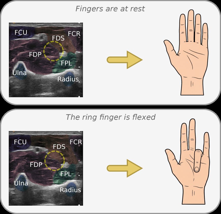 SonoRank: Towards Calibration-Free Real-Time Finger Flexion Detection from Forearm Ultrasound Sequences Figure 1