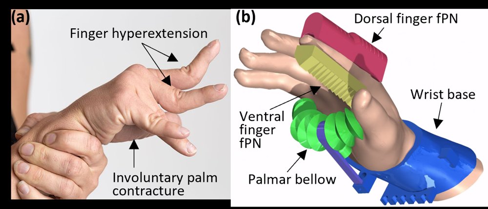 Towards Soft Robotic Exogloves for Musculoskeletal Manipulation to Reduce Pain and Spasticity Figure 1