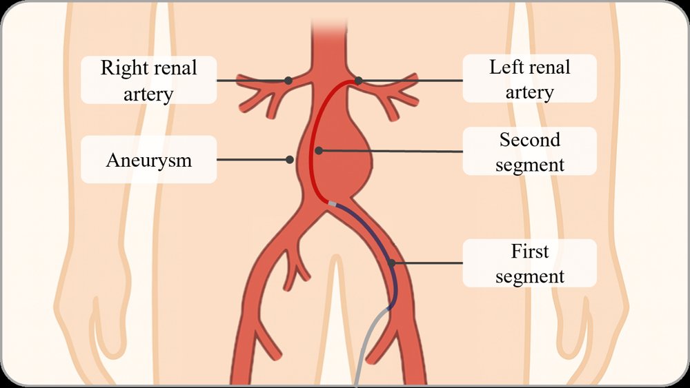 Modular Robotic Catheters for Endovascular Aneurysm Repair Figure 1