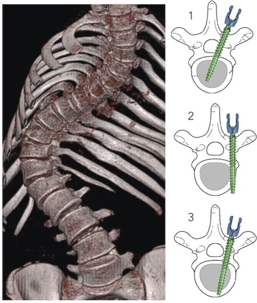 Ex vivo breach detection using electrical conductivity during robotic pedicle drilling in the spine Figure 1