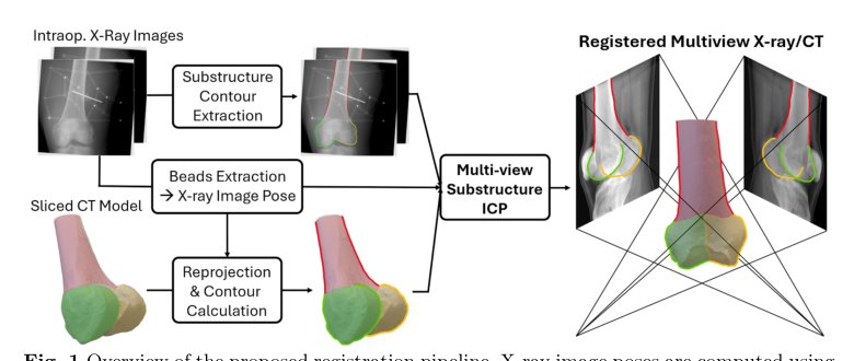 Automatic Multi-View X-Ray/CT Registration Using Bone Substructure Contours Figure 1
