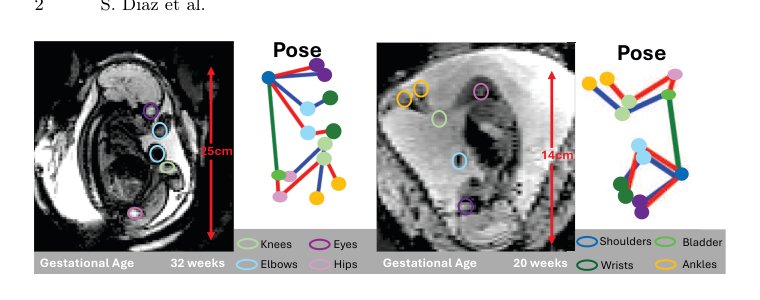 Robust Fetal Pose Estimation across Gestational Ages via Cross-Population Augmentation Figure 1
