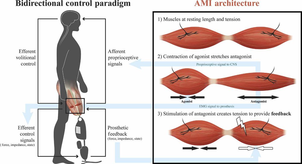 On prosthetic control: A regenerative agonist-antagonist myoneural interface Figure 1