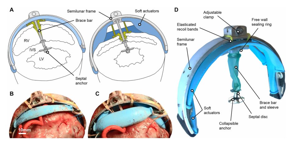 Soft robotic ventricular assist device with septal bracing for therapy of heart failure Figure 1