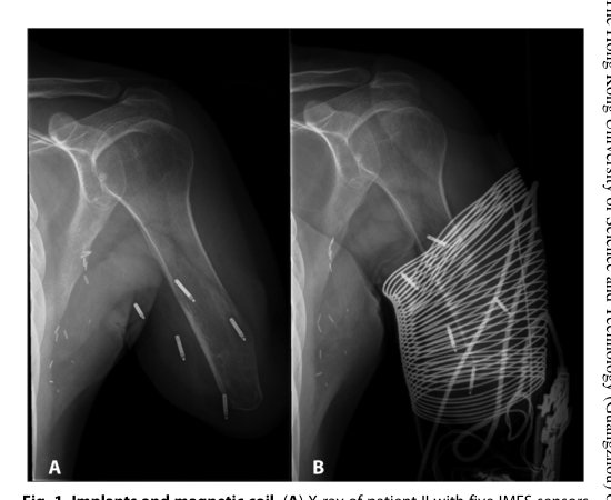 Long-term implant of intramuscular sensors and nerve transfers for wireless control of robotic arms in above-elbow amputees Figure 1