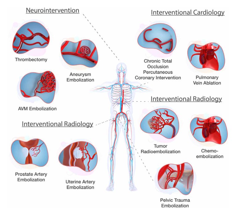 Soft robotic steerable microcatheter for the endovascular treatment of cerebral disorders Figure 1