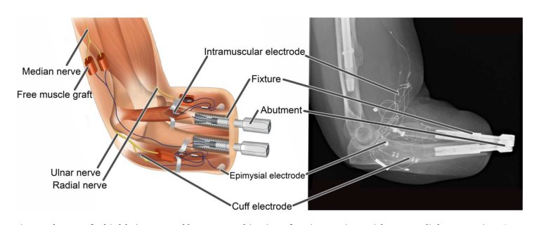 A highly integrated bionic hand with neural control and feedback for use in daily life Figure 1