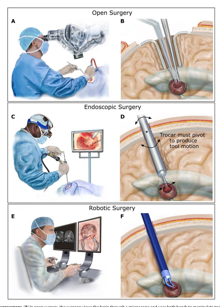 Using robotics to move a neurosurgeon’s hands to the tip of their endoscope Figure 1