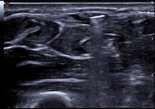 Restoration of grasping in an upper limb amputee using the myokinetic prosthesis with implanted magnets Figure 1