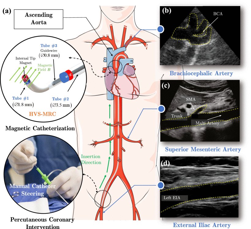 Design and Hierarchical Control of a Homocentric Variable-Stiffness Magnetic Catheter for Multiarm Robotic Ultrasound-Assisted Coronary Intervention Figure 1