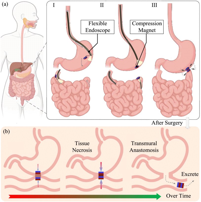 A MagsL-HUD Endoscopic System for Magnetic Compression Anastomosis Surgery in Unstructured Endoluminal Environment Figure 1